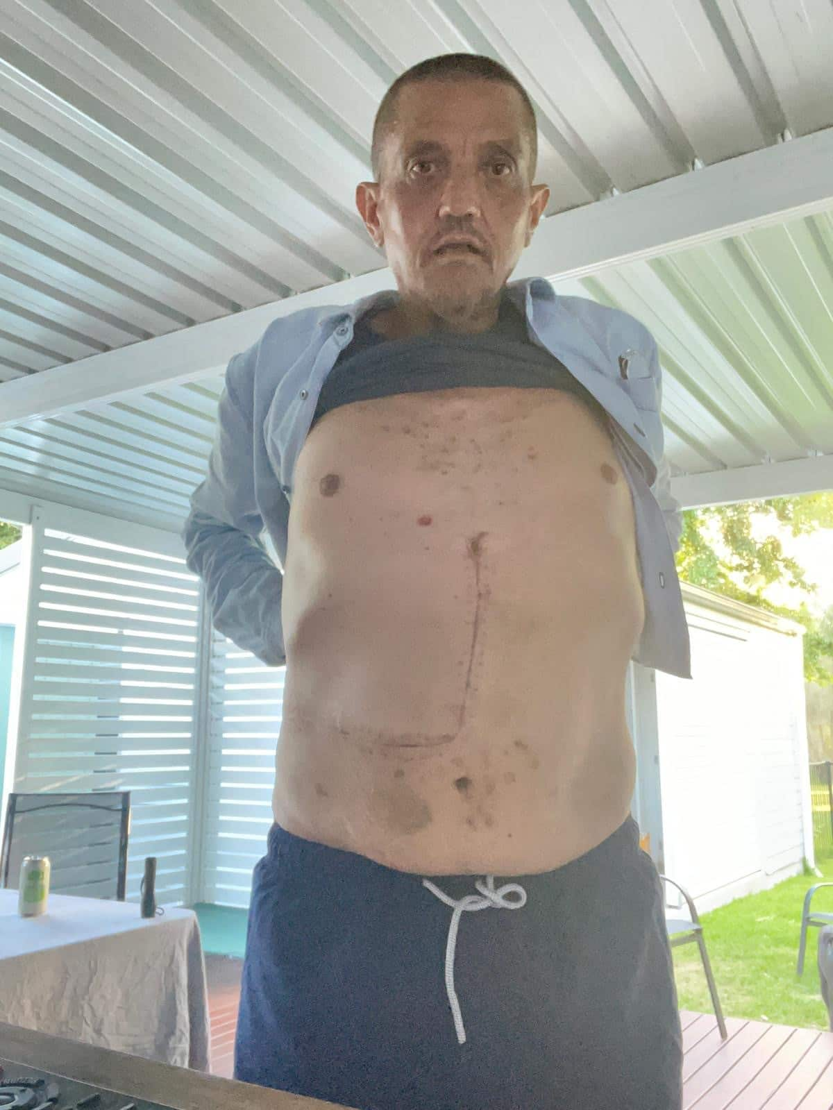 A man lifts his shirt to reveal an L-shaped scar along his stomach.